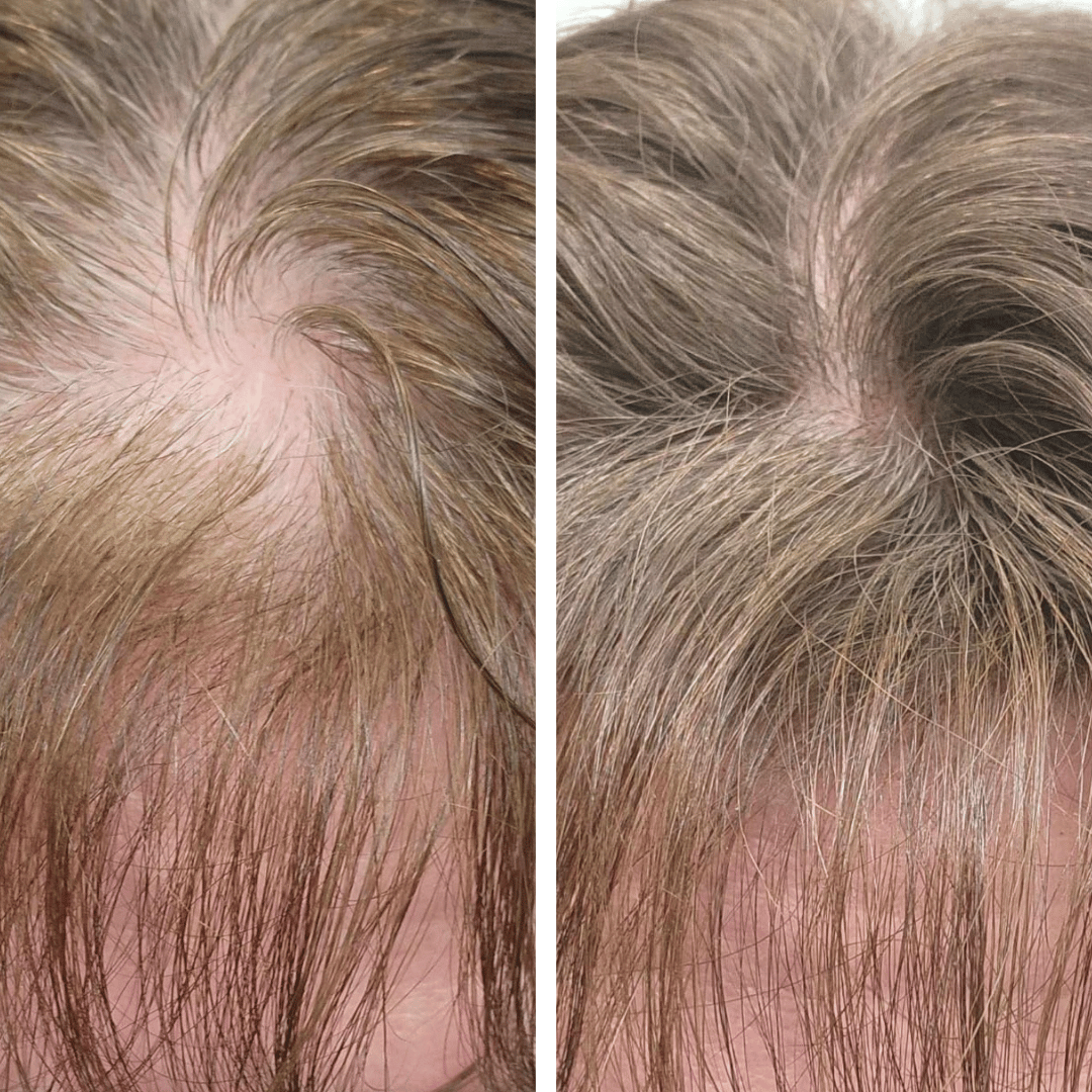 Driova - Cobertura de Raíz Invisible